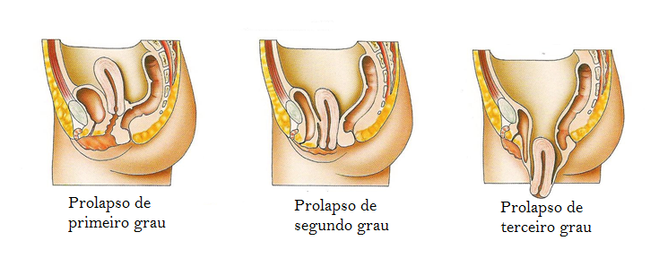 Fisioterapia Pélvica e Prolapsos Femininos